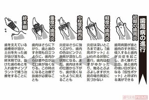 【図解】歯周病の進行　イラスト／とげとげ。