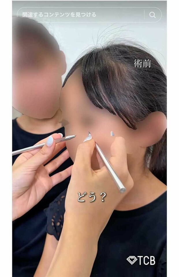 夏休み中の10歳の女子小学生が二重整形を受ける様子を動画投稿したTCB東京中央美容外科・新宿東口院の医師(TikTokより)