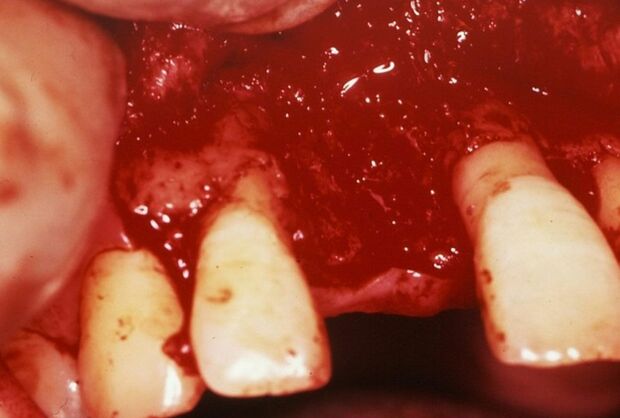 歯槽骨が減っている場合は再生治療も