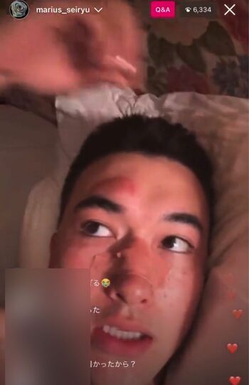 インスタグラムで痛々しく怪我をした顔面を見せるマリウス葉