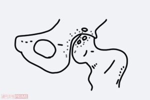 3.進行期股関節症（イラスト／赤松かおり）