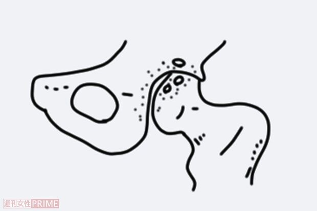 3.進行期股関節症（イラスト／赤松かおり）