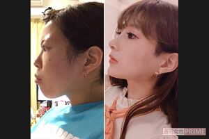 セクシー女優・高嶋めいみさんの整形ビフォーアフター