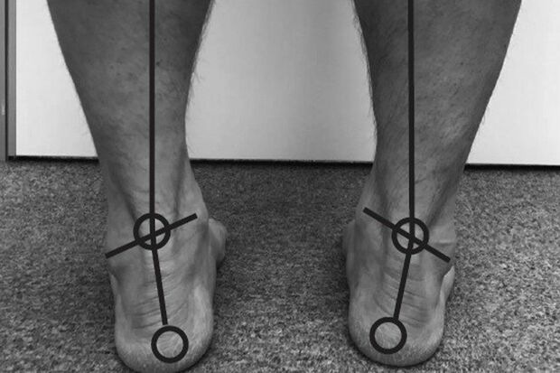 外側がすり減っている人は…猫背やガニ股が癖でお腹がぽっこり出ているタイプ