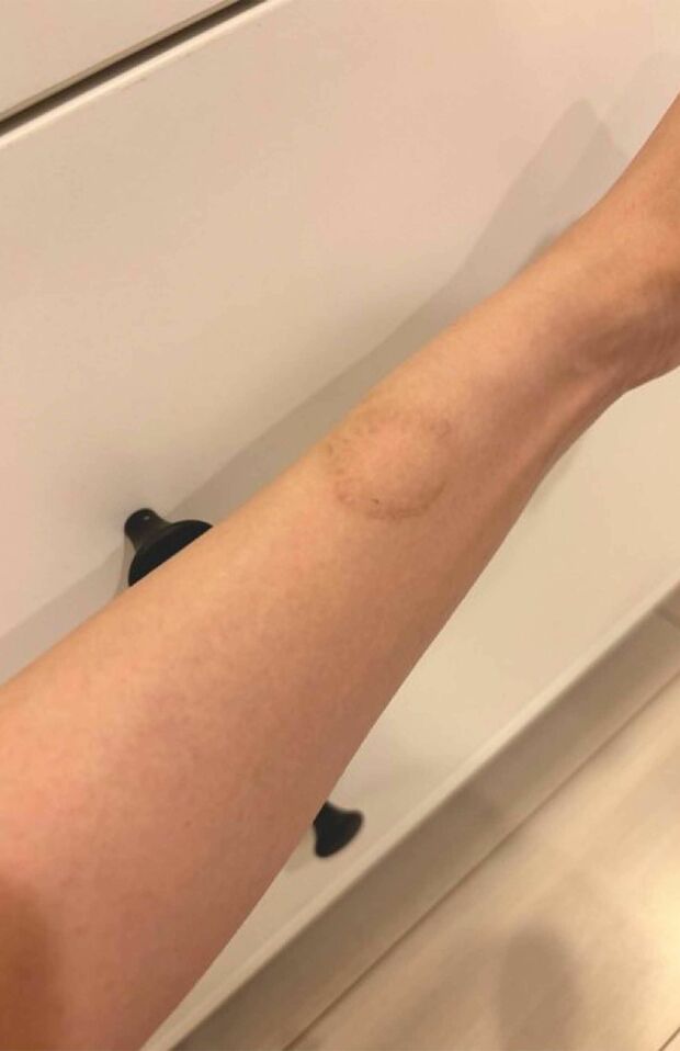 現在、犯人に噛まれた梁さんの腕の傷は回復しつつあるという