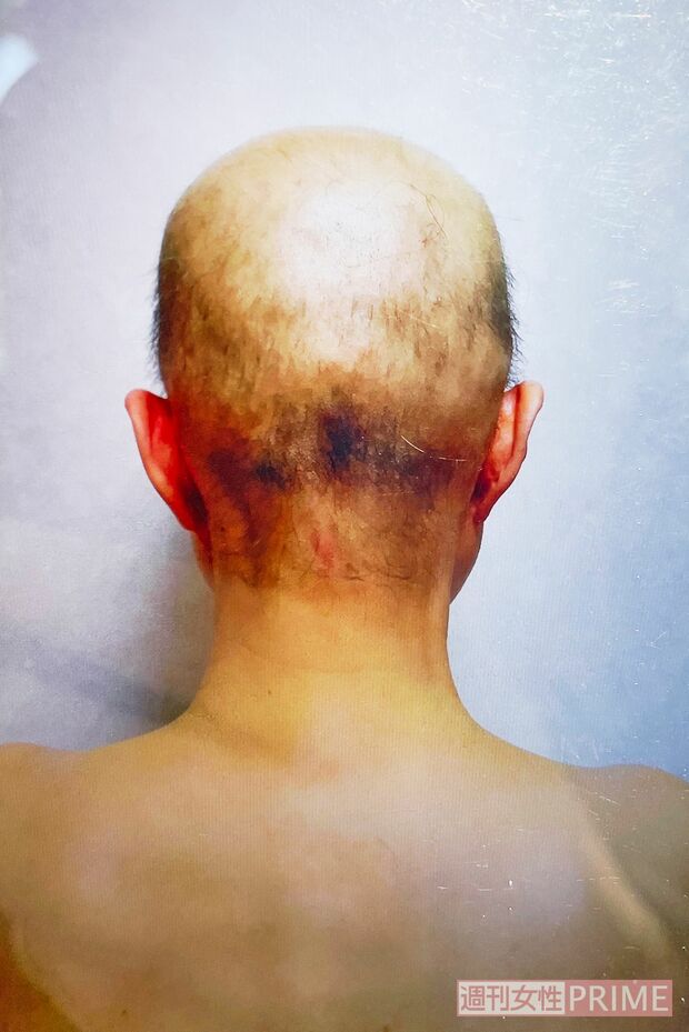 抗がん剤の副作用で髪が抜け落ちたころの写真