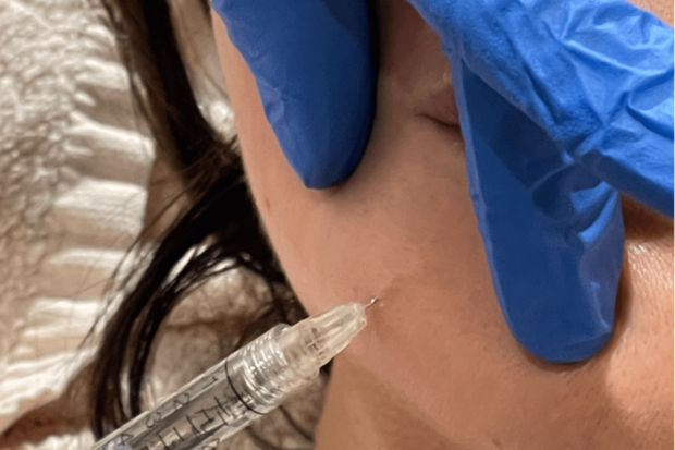 口角下のシワに、ボトックス注射とヒアルロン酸をダブルで注入！