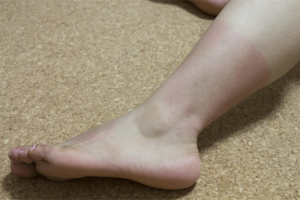 日焼けによる紫外線ダメージの蓄積はシミの原因に！（※画像はイメージです）