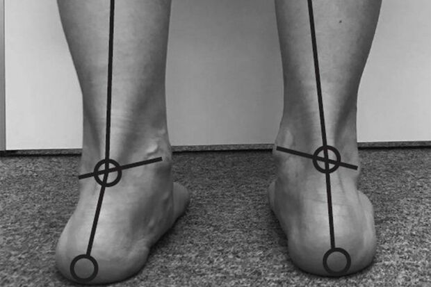 内側がすり減っている人は…外反母趾や扁平足に悩んでいる人が多いのがこのタイプ