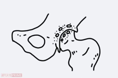 4.末期股関節症（イラスト／赤松かおり）