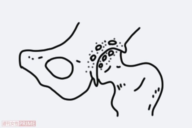 4.末期股関節症（イラスト／赤松かおり）