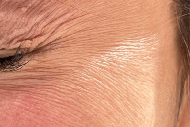 目尻施術前。瞼を強く閉じるとかなりシワが目立つ