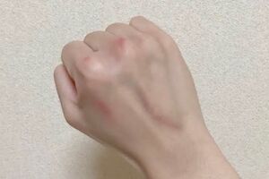 手を喉に突っ込み嘔吐するときに写真のようなタコができるようになる。これが「吐きダコ」と呼ばれ、大食い系ユーチューバーなどの手を見る視聴者も多い