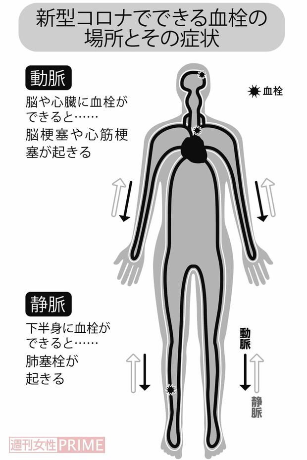 新型コロナでできる血栓の場所とその症状