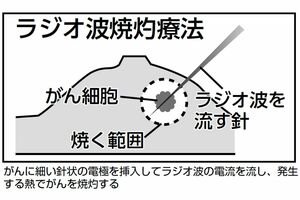 ラジオ波焼灼療法の図解