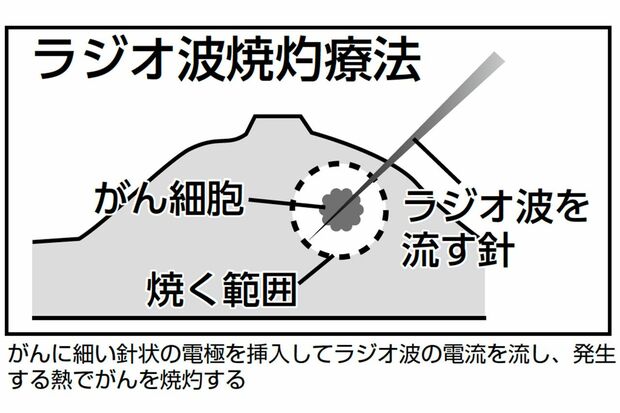 ラジオ波焼灼療法の図解