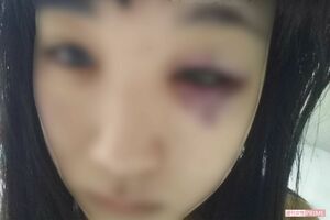 転んでぶつけたと片瀬美月さんが言っていたアザの写真だが、殴られたようにも見える