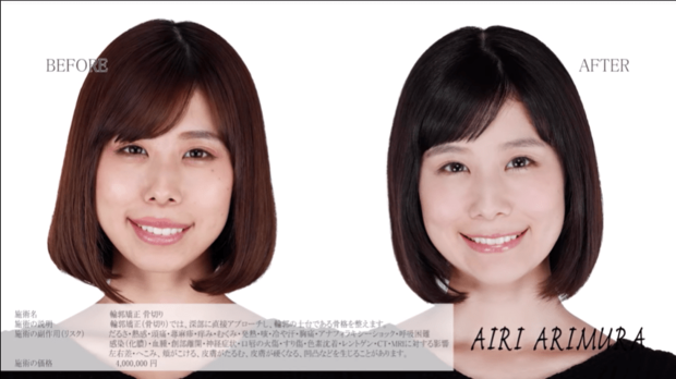 術前（左）と術後（右）。（手術を担当したレグノクリニックの公式サイトより）