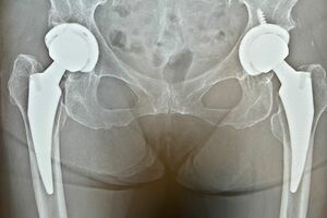 昨年の7月に術後5年を迎えた定期検診で撮影したレントゲン。白色が濃い部分が置き換えた人工股関節（本人提供）