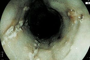 カンジダ（カビ）感染が疑われる食道のカメラ画像、白くプチプチしたものが目視できる