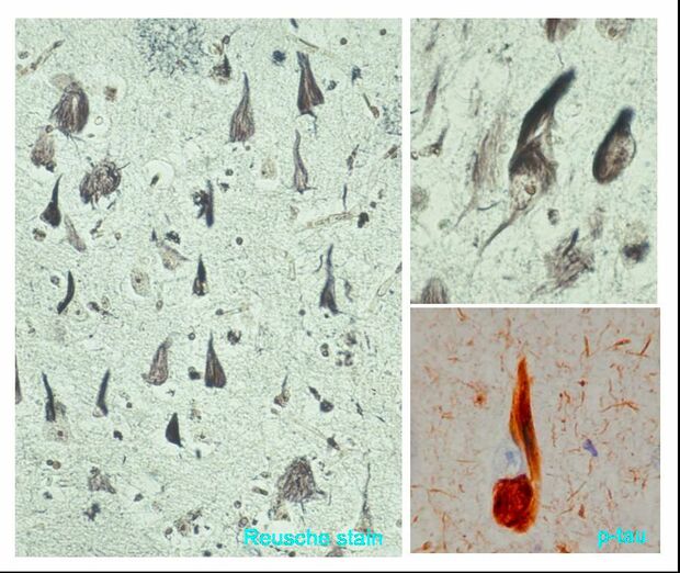 細長く黒い部分がリン酸化タウが線維状に蓄積した神経細胞