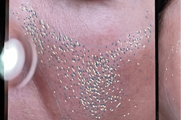 VISIA（R）での診断結果！シミやシワ、くすみなど様々な状態がわかります