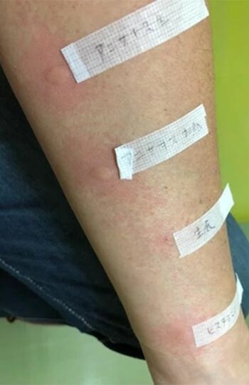 アレルゲンを直接皮膚に刺すプリックテストは、血液検査より正確にアレルゲンが特定できる。日本では未実施の病院が多く「アニサキスを捕まえて持参するなら」という条件でテストを受けた結果、皮膚が大きく腫れあがった