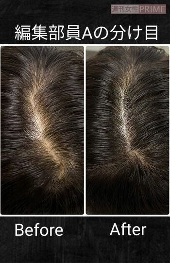 自分では頭頂部を見ていなかったので、ここまで地肌が見えているとは思いませんでした（笑）。恥ずかしい……。施術後は毛量が変わらないのにボリュームがあるように見えて大満足。育毛には時間がかかりますが、これなら1回1時間ほどでできるのでいい!