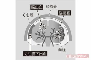 脳の血管異常で起こる病気の違い