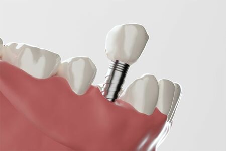 インプラント治療　※写真はイメージです