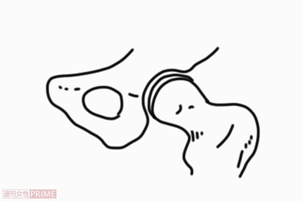 1.前股関節症（イラスト／赤松かおり）