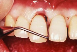 歯根の奥にある汚れは歯ぐきを切開し取る