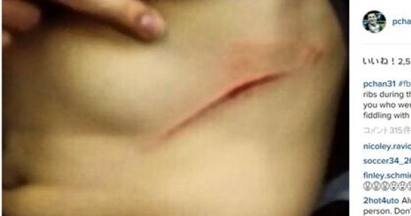 ソチ五輪後、羽生に蹴られた腹部の傷をネットで見せるチャン（公式インスタグラムより）