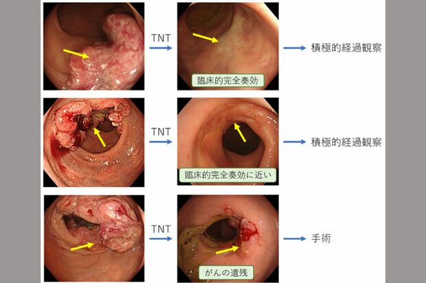 直腸がんに対して集学的治療を行うと、がんが明らかに縮小し、肉眼的にほぼ消失した状態になるという3例。手術をするかはその後の判断（公益財団法人がん研究会HPより）