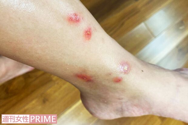 奄美大島の女性がスケベ虫に刺された痕。刺されたら皮膚科へ