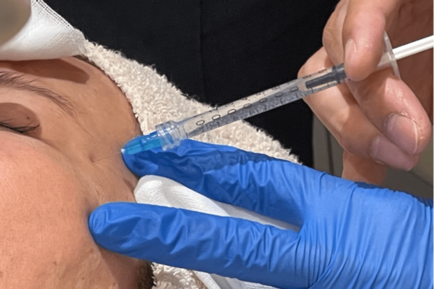 目尻にボトックス注射！