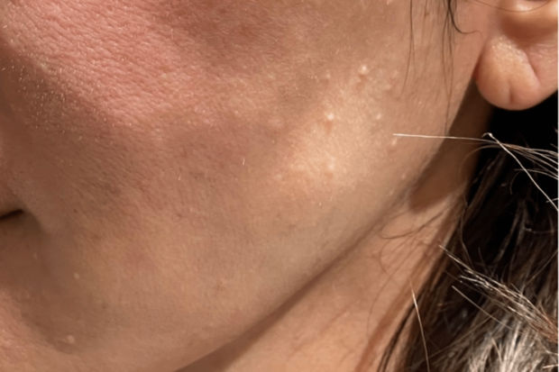 稗粒腫術前、このブツブツが手に引っかかる感じでとてもいやでした