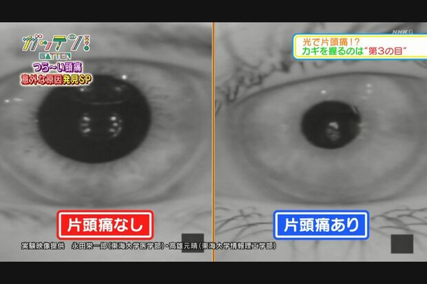 【目に光を当てたとき】片頭痛のない人（左）に比べ、片頭痛のある人（右）は瞳孔がより収縮している。（画像提供◎東海大学医学部 永田栄一郎さん、東海大学情報理工学部 高雄元晴さん）