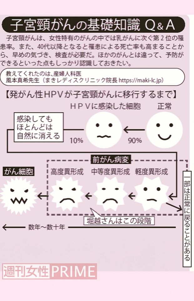 発がん性HPVが子宮頸がんに移行するまで
