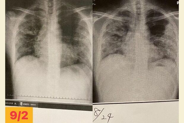 右・8月24日、東京1回目の入院で、退院2日前、左・9月2日、愛知県の病院で撮ったレントゲン写真（写真：取材者提供／東洋経済オンライン）