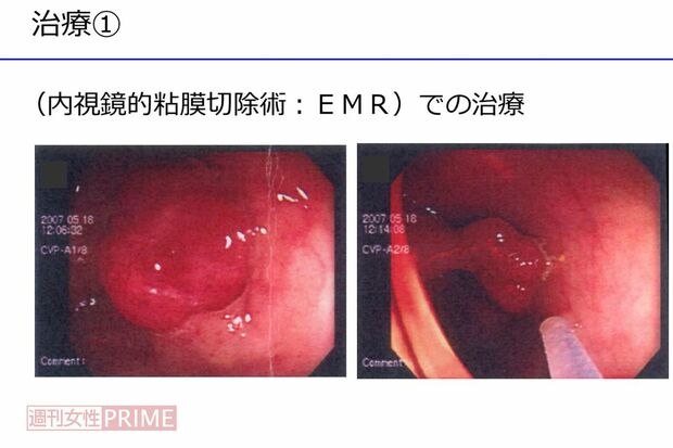 内視鏡的粘膜除去手術で大腸のポリープの摘出を行った。このポリープが悪性だったのだ