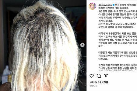 髪が抜けたことを報告した韓国のDJSODA(本人の公式インスタグラムより)