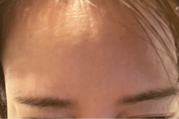 ボトックス眉間術後！やっぱりシワが出にくい（驚）