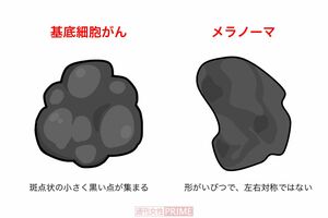 皮膚がん　イラスト／青井亜衣