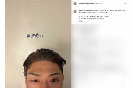 《目が痒い》顔にも蕁麻疹の症状が出たゴールデンボンバーの樽美酒研二（本人のインスタグラムより）