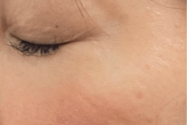 目尻術後通常時！腫れも内出血もあまり目立ちません。