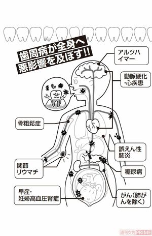 歯周病が全身へ悪影響を及ぼす！　イラスト／とげとげ。