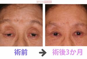 眼瞼下垂の手術を受けた患者のビフォーアフター　写真提供＝小室主任教授