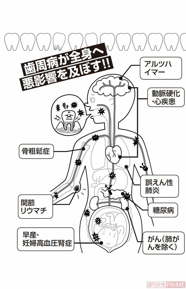 歯周病が全身へ悪影響を及ぼす！　イラスト／とげとげ。