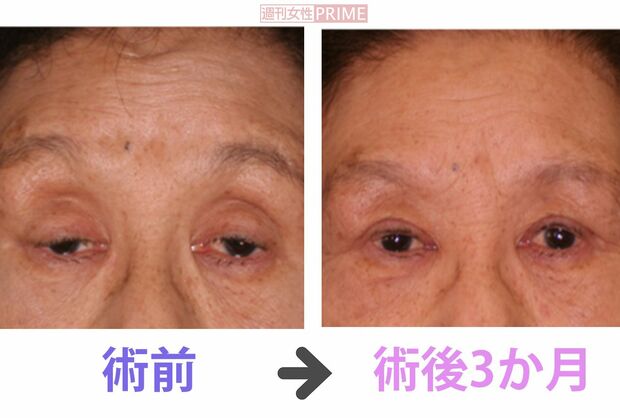 眼瞼下垂の手術を受けた患者のビフォーアフター　写真提供＝小室主任教授